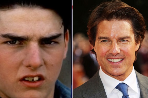 Tom Cruise Chirurgie dentaire