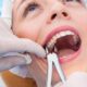 Extraction dents de sagesse Tunisie