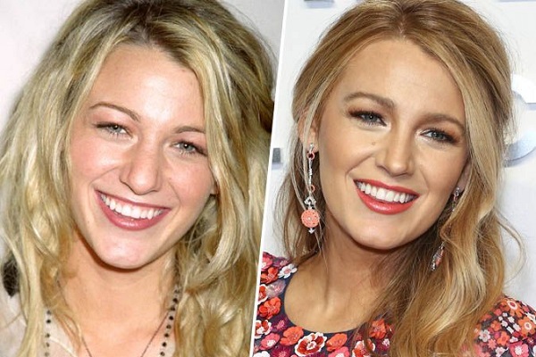 Blake-Lively chirurgie dentaire