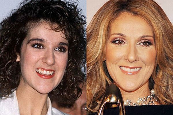 Céline Dion Chirurgie dentaire avant et après