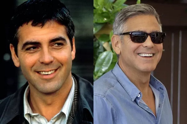 George Clooney chirurgie dentaire
